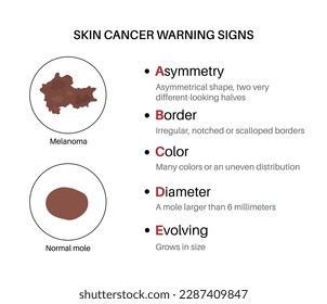 Melanoma and normal mole comparison, skin cancer warning signs, ABCDE rules poster. Malignant tumor melanocyte cells growing into skin layers. Oncology prevention medical flat vector illustration