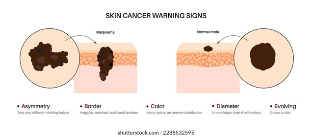 Melanoma and normal mole comparison, skin cancer warning signs, ABCDE rules poster. Malignant tumor melanocyte cells growing into skin layers. Oncology prevention medical flat vector illustration