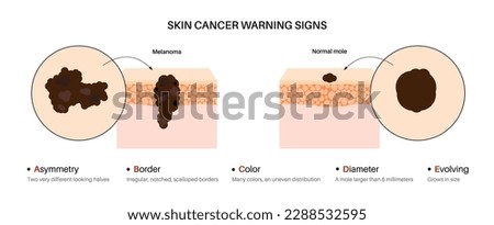 Melanoma and normal mole comparison, skin cancer warning signs, ABCDE rules poster. Malignant tumor melanocyte cells growing into skin layers. Oncology prevention medical flat vector illustration
