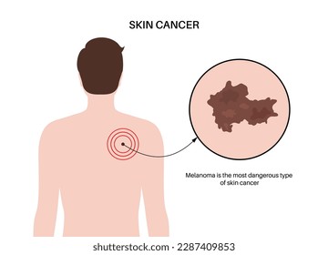 Melanoma en la espalda de un hombre, desarrollo de cáncer de piel. Diagnóstico y tratamiento de tumores malignos. Pigmento que produce células de melanocitos. Examen de dermatología en la ilustración plana de laboratorio vectorial