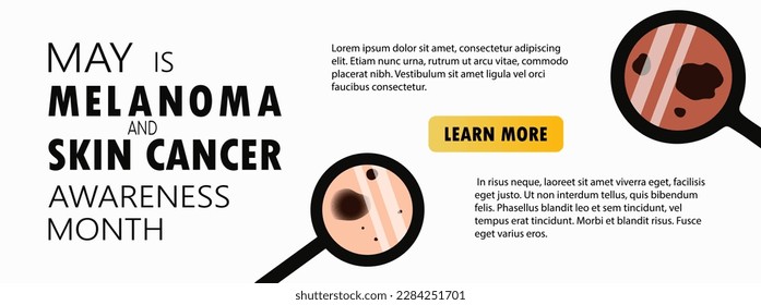 Melanoma and skin cancer awareness month landing page template. Banner template with moles, birthmarks under magnifying glass and copy space for text. Vector illustration