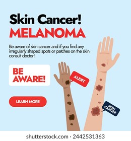 Melanoma Skin cancer. Skin cancer awareness post with two different ethnic hands having Melanoma cancer spots. Awareness social media post for Skin Cancer Patients. Melanoma warning signs.