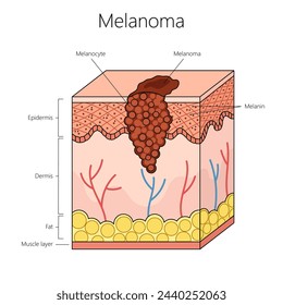 melanoma skin cancer with a focus on melanocyte and skin layers including the epidermis and dermis structure diagram hand drawn schematic vector illustration. Medical science educational illustration