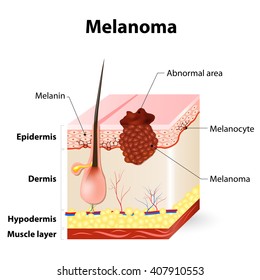 Melanoma or skin cancer. layers of the human skin.