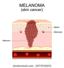 Melanoma. Skin cancer that originates from melanocytes. Layers and structure of human skin. Cross section of skin. Vector illustration