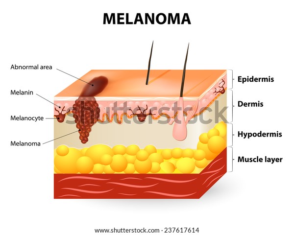 Melanoma Skin Cancer This Rare Type Stock Vector (Royalty Free) 237617614