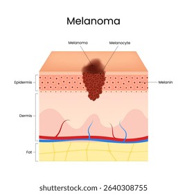 Melanoma Symptoms Diagram of Skin Cancer