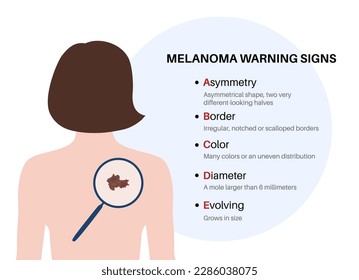 Señales de advertencia de melanoma. Regla ABCDE para el cáncer de piel. Forma asimétrica, borde irregular, muchos colores, gran diámetro, tamaño cambiante del topo. Prevención oncológica carteles médicos ilustración vectorial plana.