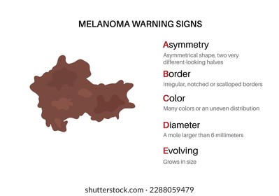 Melanoma warning signs. ABCDE rule for skin cancer. Asymmetrical shape, irregular border, many colors, big diameter, evolving size of mole. Oncology prevention medical poster flat vector illustration.