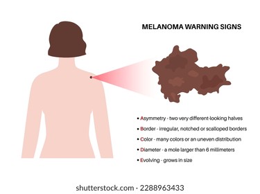 Melanoma warning signs. ABCDE rule for skin cancer. Asymmetrical shape, irregular border, many colors, big diameter, evolving size of mole. Oncology prevention medical poster flat vector illustration.