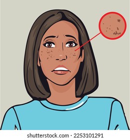 melasma, cuidado de la salud y concepto de cuidado de la piel con problemas. manchas oscuras, pecas, piel seca en la cara.