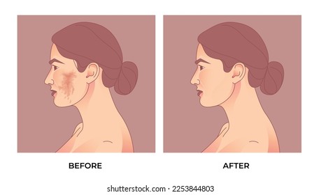 Melasma en la cara de la mujer. antes y después del tratamiento facial con pigmentación de melasma.