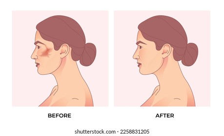 Melasma on woman face. before and after melasma pigmentation facial treatment.