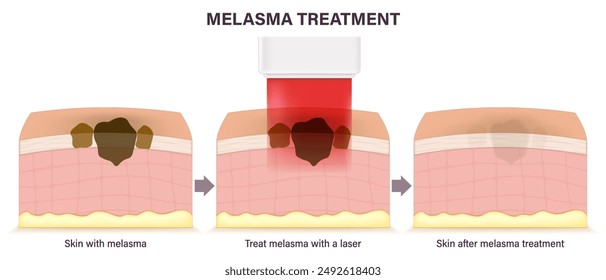 Melasma-Behandlung mit Laser. Hautschichten vor, während und nach der Melasmabehandlung mit Laser. In: Cosmetic Laser Dermatology.