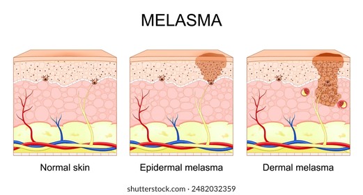 Melasma. Types of chloasma faciei. Cross section of human skin with Hyperpigmentation. Dermal and Epidermal melasma. Mask of pregnancy. Vector illustration