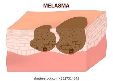 Melasma vector. Epidermal and dermal melasma. Facial skin problems. Human skin with hyperpigmentation.