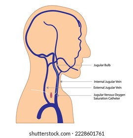 Men head and neck silhouette with venous vessels illustration and a Bulb jugular catheter placed