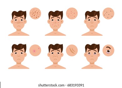 Men skin problem. Acne men. Vector illustration.