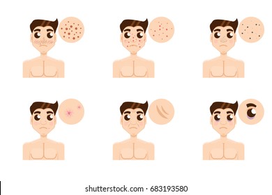 Men skin problem. Acne men. Vector illustration.