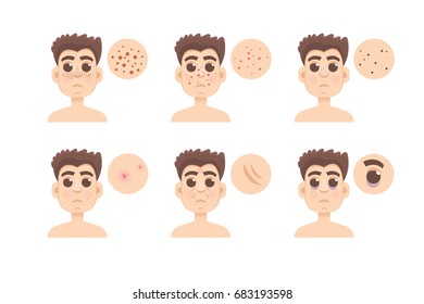 Men skin problem. Acne men. Vector illustration.