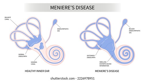 The Meniere's disease of sound in stuffy ear hear ringing roaring buzzing loss of balance dizzy spells pressure headache