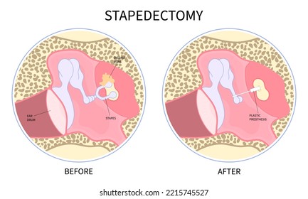 Meniere's Syndrome With Stapedectomy Surgical For Hearing Loss And Balance Problem