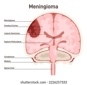 Meningioma. Brain tumor that forms from the meninges, the membranous layers surrounding the brain. Human brain structure anayomy. Flat vector illustration