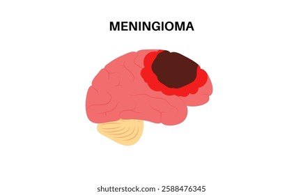 Meningioma cancer medical poster. Tumor on the membranes that surround the brain and spinal cord. Meninges inflammation. Neoplasm in the head, central nervous system problem flat vector illustration