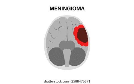 Meningioma cancer medical poster. Tumor on the membranes that surround the brain and spinal cord. Meninges inflammation. Neoplasm in the head, central nervous system problem flat vector illustration