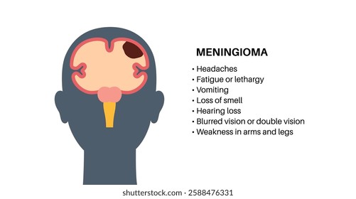 Meningioma cancer symptoms. Tumor on the membranes that surround the brain and spinal cord. Meninges inflammation. Neoplasm in the head, central nervous system problem medical flat vector illustration