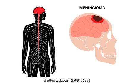 Meningioma cancer. Tumor on the membranes that surround the brain and spinal cord. Meninges inflammation. Neoplasm in the head, central nervous system problem in male silhouette vector illustration