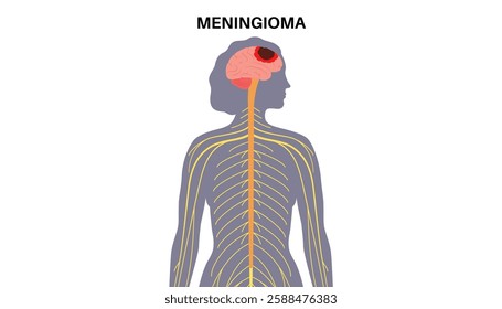 Meningioma cancer. Tumor on the membranes that surround the brain and spinal cord. Meninges inflammation. Neoplasm in the head, central nervous system problem in female silhouette vector illustration