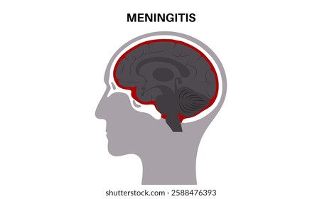 Meningitis acute or chronic inflammation of the protective layers of the brain and spinal cord. Meninges disease poster. Bacteria, viruses, fungi, parasites in the human head flat vector illustration