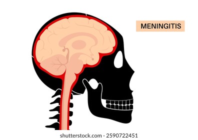 Meningitis acute or chronic inflammation of the protective layers of the brain and spinal cord. Meninges disease poster. Bacteria, viruses, fungi, parasites in the human head flat vector illustration