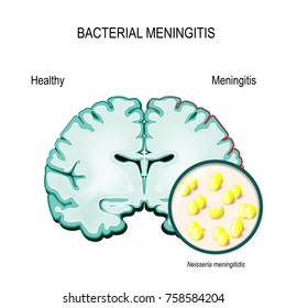 Meningitis. Human brain and meningococcal bacteria (Neisseria meningitidis).