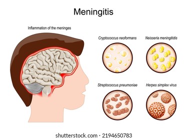 Meningitis. Human's brain with Inflammation of the meninges. Pathogens that caused this disease. The inflammation may be caused by infection with viruses, bacteria, or fungi