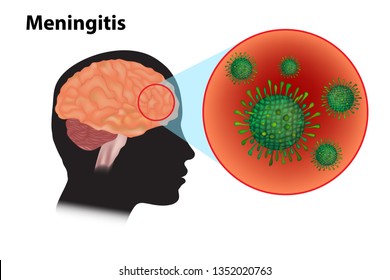 Meningitis - Inflammation Of The Brain. Viral Meningitis And Encephalitis