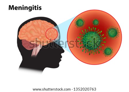 Meningitis - inflammation of the brain. Viral meningitis and encephalitis