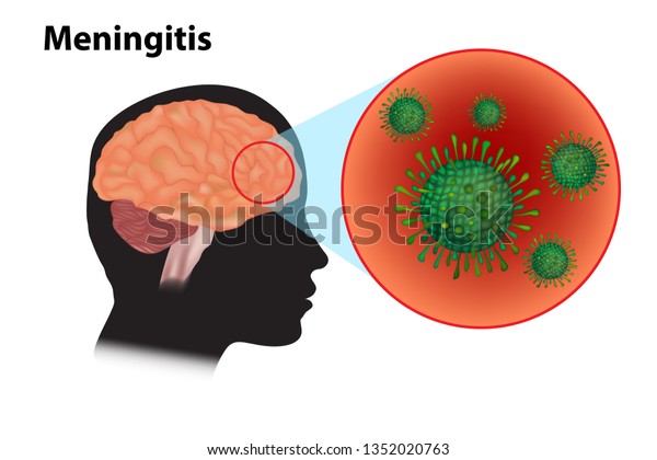 Meningitis - inflammation of the brain.\
Viral meningitis and\
encephalitis