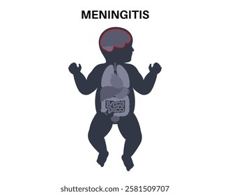 Meningitis inflammation of the protective layers surrounding the brain and spinal cord. Meninges disease medical poster. Bacteria, viruses, fungi, parasites in the baby head flat vector illustration