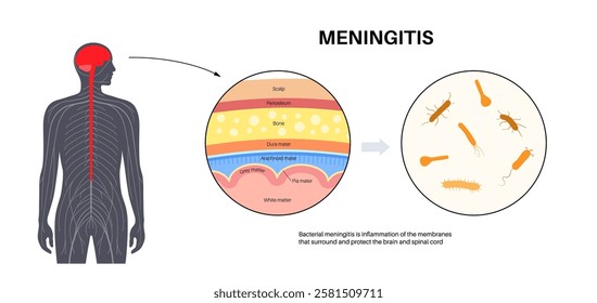 Meningitis inflammation of the protective layers surrounding the brain and spinal cord. Structure of meninges, headache diagnosis and treatment. Bacteria, viruses and fungi in the human head vector