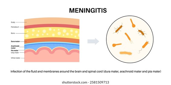 Meningitis inflammation of the protective layers surrounding the brain and spinal cord. Structure of meninges, headache diagnosis and treatment. Bacteria, viruses and fungi in the human head vector