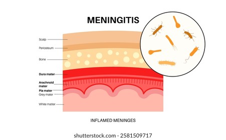 Meningitis inflammation of the protective layers surrounding the brain and spinal cord. Structure of meninges, headache diagnosis and treatment. Bacteria, viruses and fungi in the human head vector