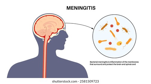 Meningitis inflammation of the protective layers surrounding the brain and spinal cord. Structure of meninges, headache diagnosis and treatment. Bacteria, viruses and fungi in the human head vector