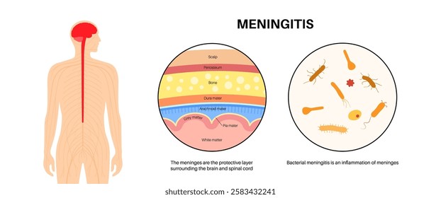 Meningitis inflammation of the protective layers surrounding the brain and spinal cord. Structure of meninges, headache diagnosis and treatment. Bacteria, viruses and fungi in the human head vector