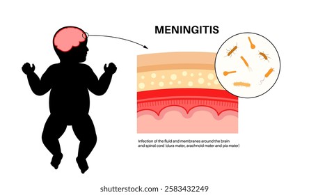 Meningitis inflammation of the protective layers surrounding the brain and spinal cord. Meninges disease medical poster. Bacteria, viruses, fungi, parasites in the baby head flat vector illustration