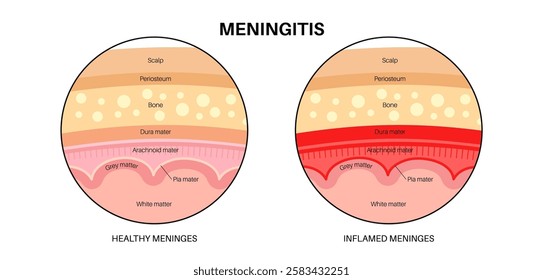 Meningitis inflammation of the protective layers surrounding the brain and spinal cord. Structure of meninges, headache diagnosis and treatment. Bacteria, viruses and fungi in the human head vector