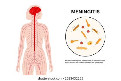 Meningitis inflammation of the protective layers surrounding the brain and spinal cord. Structure of meninges, headache diagnosis and treatment. Bacteria, viruses and fungi in the human head vector