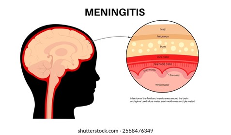 Meningitis inflammation of the protective layers surrounding the brain and spinal cord. Meninges disease medical poster. Bacteria, viruses, fungi, parasites in the baby head flat vector illustration