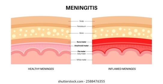 Meningitis inflammation of the protective layers surrounding the brain and spinal cord. Structure of meninges, headache diagnosis and treatment. Bacteria, viruses and fungi in the human head vector